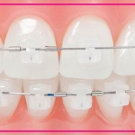 مراقبت های لازم بعد از ارتودنسی دندان