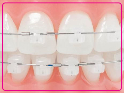 مراقبت های لازم بعد از ارتودنسی دندان